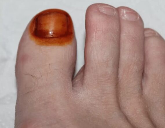 Θεραπεία του μανιταριού yod