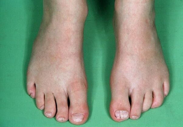 Ο μύκητας στα πόδια