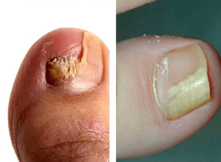 Ασθένεια μανιταριών