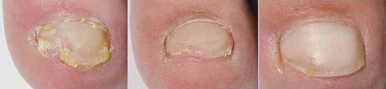 Αποτελέσματα θεραπείας