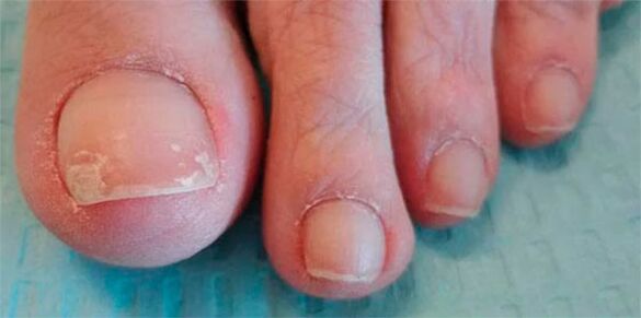 Φάσεις των ποδιών μανιταριών